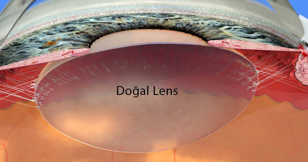 Gözün Doğal Lensi