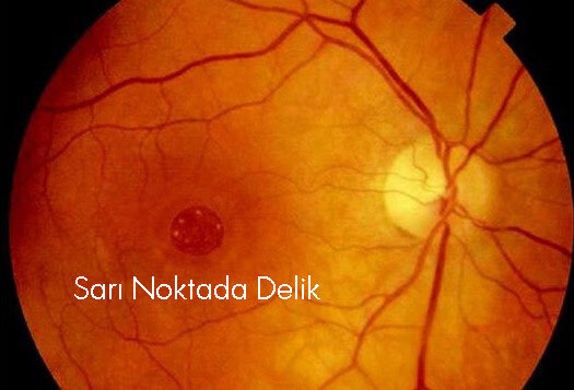 Maküler Hole-Sarı Nokta Deliği