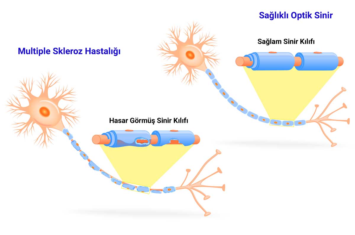 Optik Nevrit ve Multiple Skleroz Hastalığı-MS Hastalığı