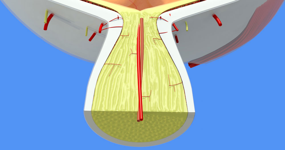 Retinal Arter Tıkanıklığı